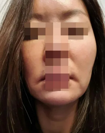 Cấy mỡ dưới mắt, căng da mặt