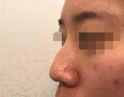 Mình để lại đánh giá sau 4 tháng phẫu thuật!! ᄒᄒᄒ