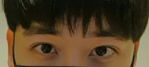 Cắt mí (rạch), chỉnh hình mắt, hạ đường mí