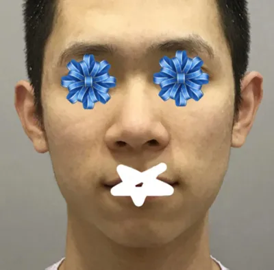 Review sau phẫu thuật thẩm mỹ mũi và đường nét khuôn mặt nam