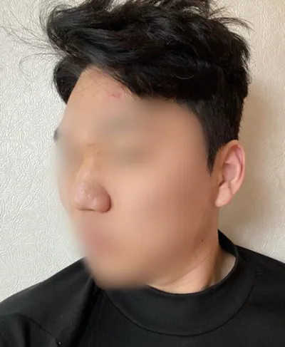 Nâng sống mũi, chỉnh hình đầu mũi, chỉnh mũi to, thu nhỏ xương mũi