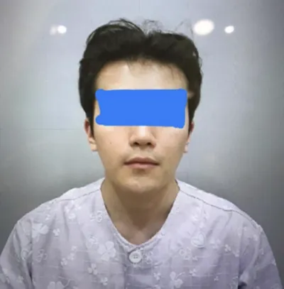 Gọt hàm vuông, thu nhỏ xương gò má, độn cằm, cắt bỏ vỏ xương, laser Venus, tiêm tan mỡ