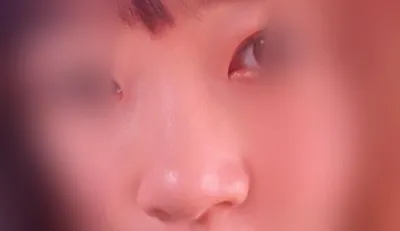 Mình đã tiêm filler mũi tại Bệnh viện phẫu thuật thẩm mỹ Jayjun :)