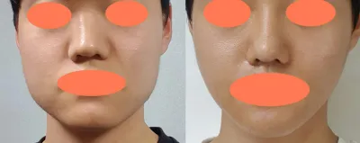 Gọt hàm vuông, cắt gọt vỏ xương, thu nhỏ cơ cắn