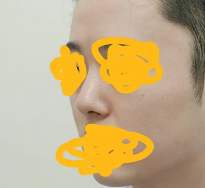 Mình đã phẫu thuật lại mũi ở Jayjun vì không hài lòng với chiếc mũi đã làm vài năm trước.