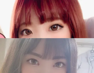 Cắt mí (chôn chỉ), mở góc mắt trong