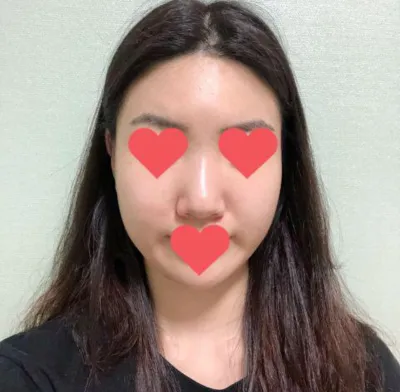 Đánh giá sau 2 năm phẫu thuật mũi