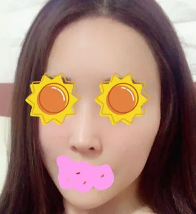 Review sau 1 năm rưỡi phẫu thuật thu nhỏ xương gò má!