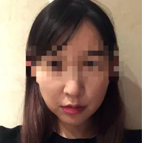 Mình đã phẫu thuật căng da mặt tại Jayjun và bây giờ đã được 3 tuần.