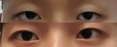 #Cắt mí mắt không phẫu thuật