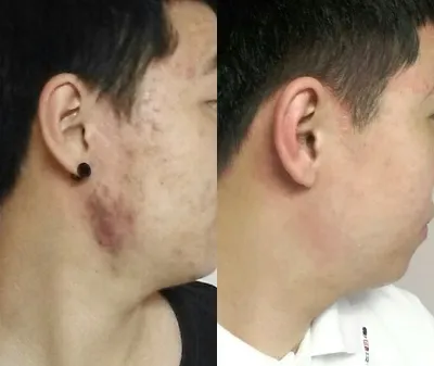 Đánh giá sau 6 tháng điều trị mụn