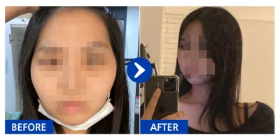 [Babitalk] Phẫu thuật khuôn mặt / 1 tháng / Biệt danh: Daramwi