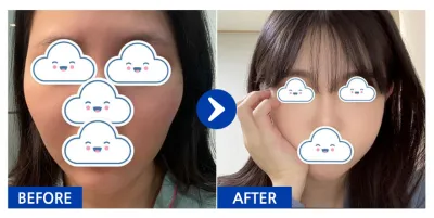 [Babitalk] Phẫu thuật gọt mặt / Tháng thứ 3 / Biệt danh: orini_i