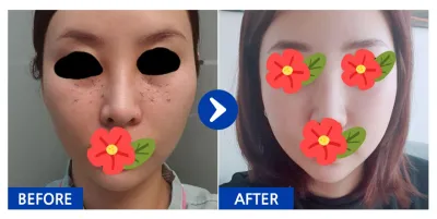 [Babitalk] Gọt mặt, tái cấu trúc mỡ mí mắt dưới / Tháng thứ 2 / Biệt danh: Yam Yam Yam Yam 123