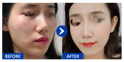 [Babytalk] Gọt mặt / Tháng thứ 3 / Nickname: dbdbdla@