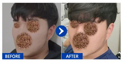 [Babitalk] Phẫu thuật đường nét khuôn mặt / Tháng thứ 3 / Biệt danh: 안능웅