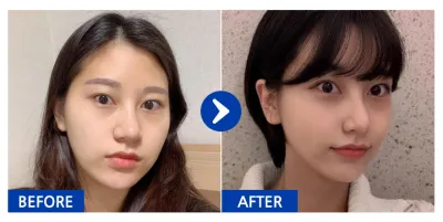 [Babitalk] Phẫu thuật khuôn mặt, cấy mỡ / Tháng thứ 6 / Biệt danh: Amelikalno