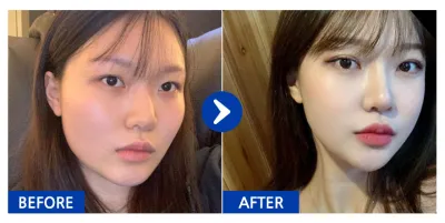 [Babytalk] Phẫu thuật đường nét khuôn mặt, cắt mí, nâng mũi / Tháng thứ 7 / Biệt danh: Seolyun2