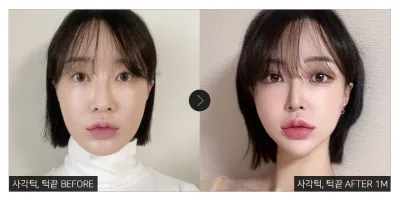 [Review Gangnam Unni] Một tháng sau phẫu thuật gọt hàm và độn cằm / Biệt danh: Ba anh em gấu