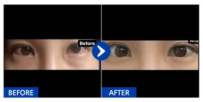 [Babitalk] Cắt mí / Tháng thứ 1 / Biệt danh: Babitokhi