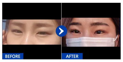 [Babitalk] Cắt mí / Tháng thứ 4 / Biệt danh: Cô nàng năng động