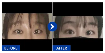 [Babytalk] Cắt mí / Tháng thứ 3 / Biệt danh: tilia20