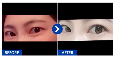 [Babytalk] Cắt mí / Tháng thứ 3 / Biệt danh: Hanasama