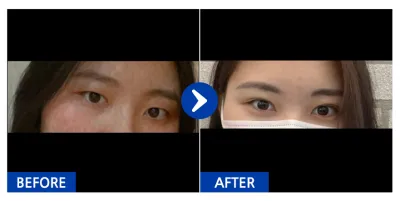 [Babitalk] Cắt mí / Tháng thứ 2 / Biệt danh: Yurim08