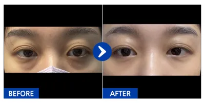 [Babitalk] Tái cấu trúc mỡ dưới mắt / 1 tháng / Biệt danh: 눈눈엉옹