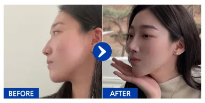 [Babitalk] Nâng mũi / Tháng thứ 5 / Biệt danh: atmospe