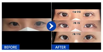 [Gangnam Unni] Nhấn mí tự nhiên / Sau 1 tháng / Biệt danh: Hwal-sswa-bi-a