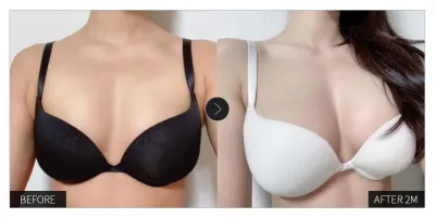 [Review Gangnam Unni] Nâng ngực tháng thứ hai / Biệt danh: Uuuunaa