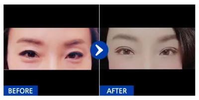 [Gangnam Unni] Cắt mí trên và dưới / Tháng thứ 1 / Biệt danh: JONABI555