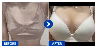 [Babitalk] Phẫu thuật nâng ngực (Sebbin Matec) / Tháng thứ 5 / Biệt danh: Hyonni-hyonni-ya