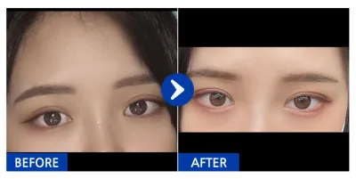 [Gangnam Unni] Nhấn mí tự nhiên / Sau 1 tháng / Biệt danh: Ddiyongㅇㅅㅇ