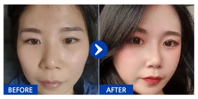 [Babitalk] Phẫu thuật nâng mũi / Tháng thứ 2 / Biệt danh: Nickname11111