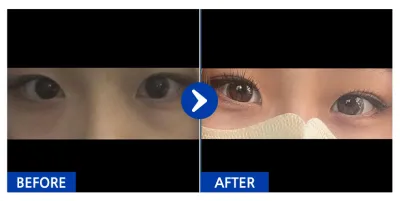 [Babitalk] Dưới mắt, mắt hai mí (nhấn mí) / Tháng thứ 2 / Biệt danh: Eon-i-eon-i-eon-di