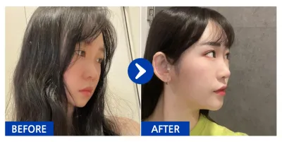 [Babitalk] Nâng mũi / Tháng thứ 6 / Biệt danh: Hyonni Hyonniya