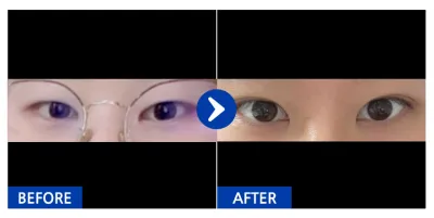 [Gangnam Unni] Mắt hai mí (nhấn mí tự nhiên) / Biệt danh: juankim