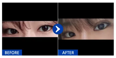 [Gangnam Unni] Nhấn mí tự nhiên / 1 tháng / Biệt danh: Borasugeon