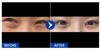 [Gangnam Unni] Tái định vị mỡ mí mắt dưới / Tháng thứ 2 / Biệt danh: dbgcgghgfd