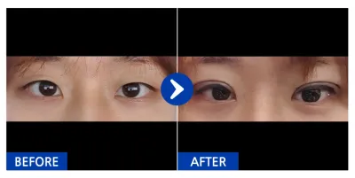 [Gangnam Unni] Nhấn mí tự nhiên / 1 tháng / Biệt danh: ㅋㄱㅋㅋㄲ