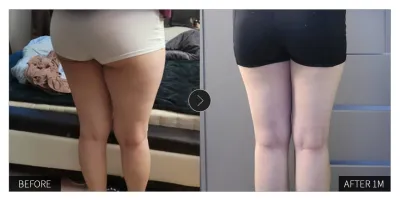 [Review Gangnam Unni] Một tháng sau khi mình hút mỡ / Biệt danh: 취저1017