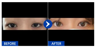 [Gangnam Unni] Cắt mí (nhấn mí tự nhiên) / Tuần 2 / Biệt danh: Nun-nu-nan-ma-nan