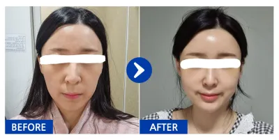 [Babitalk] Cấy mỡ / Tháng thứ 1 / Biệt danh: Yoyomon a