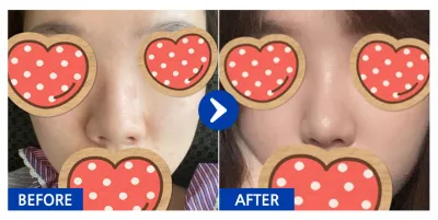 [Gangnam Unni] Nâng mũi / Sau 1 tháng / Biệt danh: yyjk3396