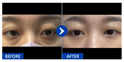 [Gangnam Unni] Tái định vị mỡ bọng mắt / Sau 1 tháng / Biệt danh: Yomi hàng xóm