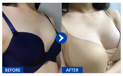 [Babytalk] Phẫu thuật ngực / Tháng thứ 5 / Biệt danh: Jeong-ssyu-gi