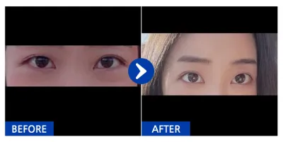 [Babitalk] Tái định vị mỡ mí mắt dưới / 1 tháng / Biệt danh: kd31