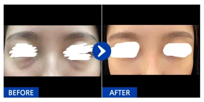 [Babitalk] Tái định vị mỡ mí mắt dưới / Sau 1 tháng / Biệt danh: Syusyusyusyusyuk